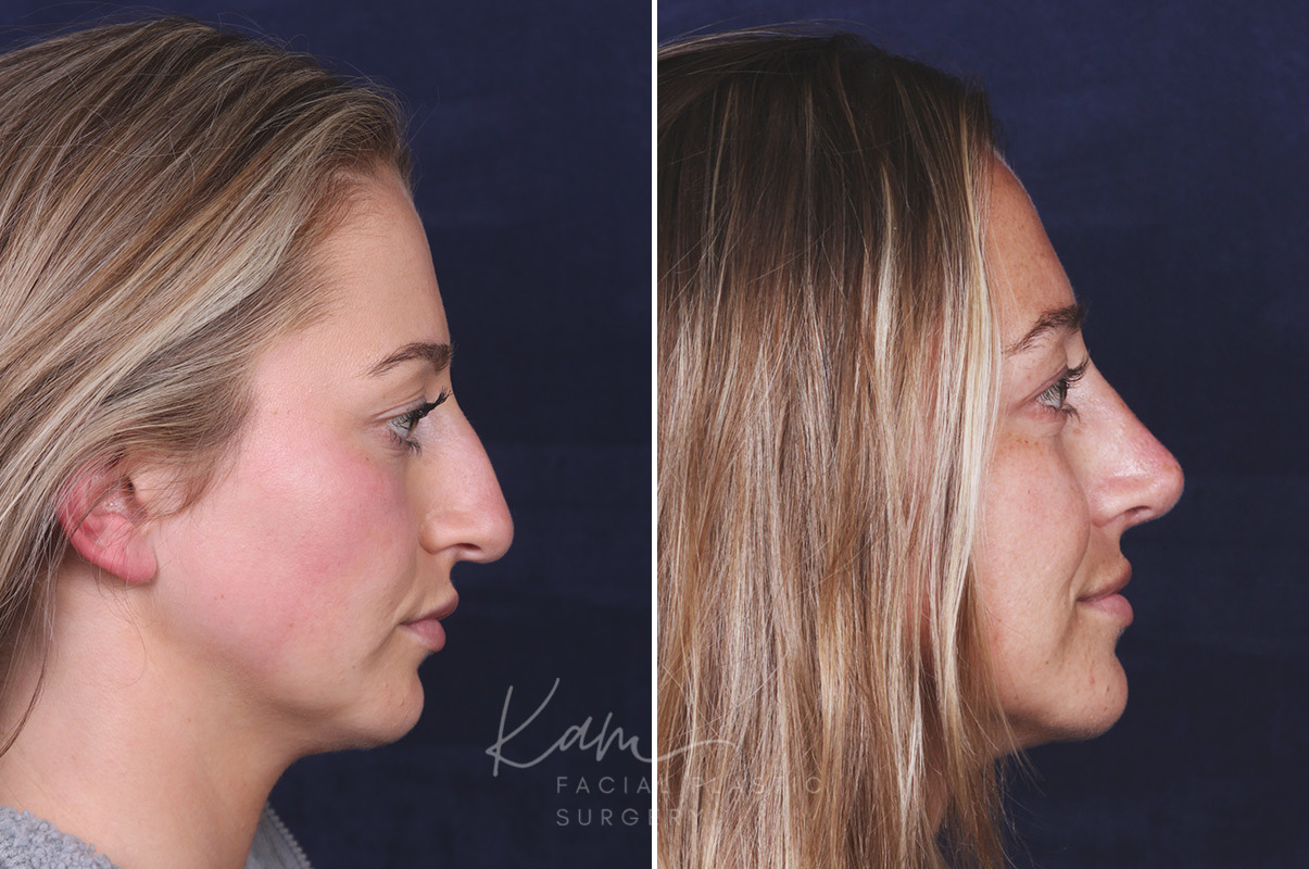 Rhinoplasty before and after photos in Voorhees, NJ, Patient 121