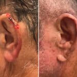 Mohs Reconstruction before and after photos in Voorhees, NJ, Patient 713