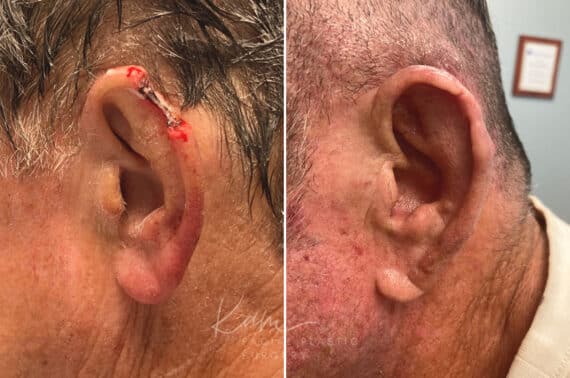 Mohs Reconstruction before and after photos in Voorhees, NJ, Patient 713