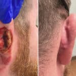 Mohs Reconstruction before and after photos in Voorhees, NJ, Patient 717