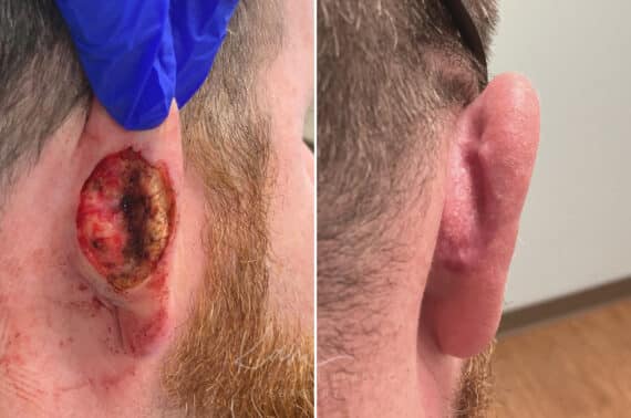 Mohs Reconstruction before and after photos in Voorhees, NJ, Patient 717