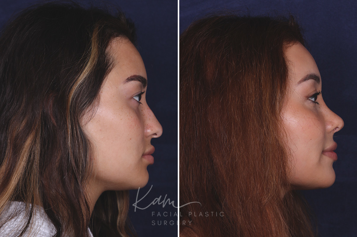 Rhinoplasty before and after photos in Voorhees, NJ, Patient 91