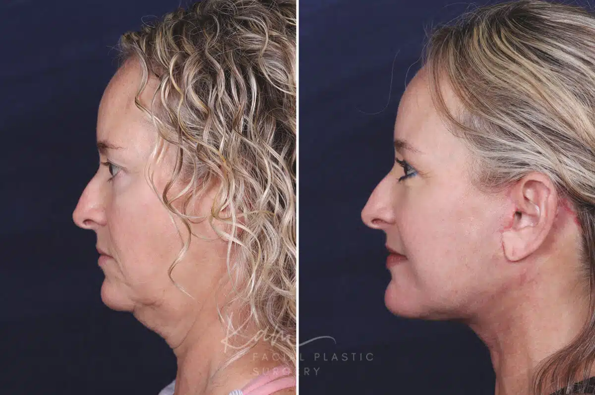 Facelift before and after photos in Voorhees, NJ, Patient 621