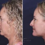 Facelift before and after photos in Voorhees, NJ, Patient 621