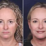 Facelift before and after photos in Voorhees, NJ, Patient 621