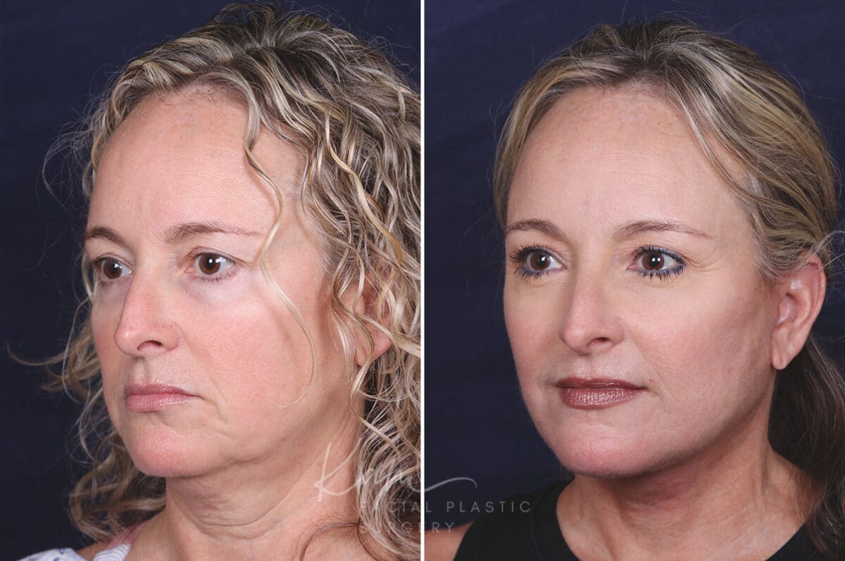 Facelift before and after photos in Voorhees, NJ, Patient 621