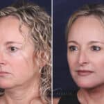 Facelift before and after photos in Voorhees, NJ, Patient 621