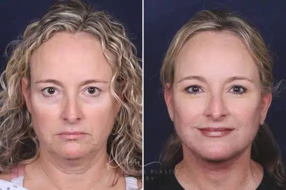 Facelift before and after photos in Voorhees, NJ, Patient 621