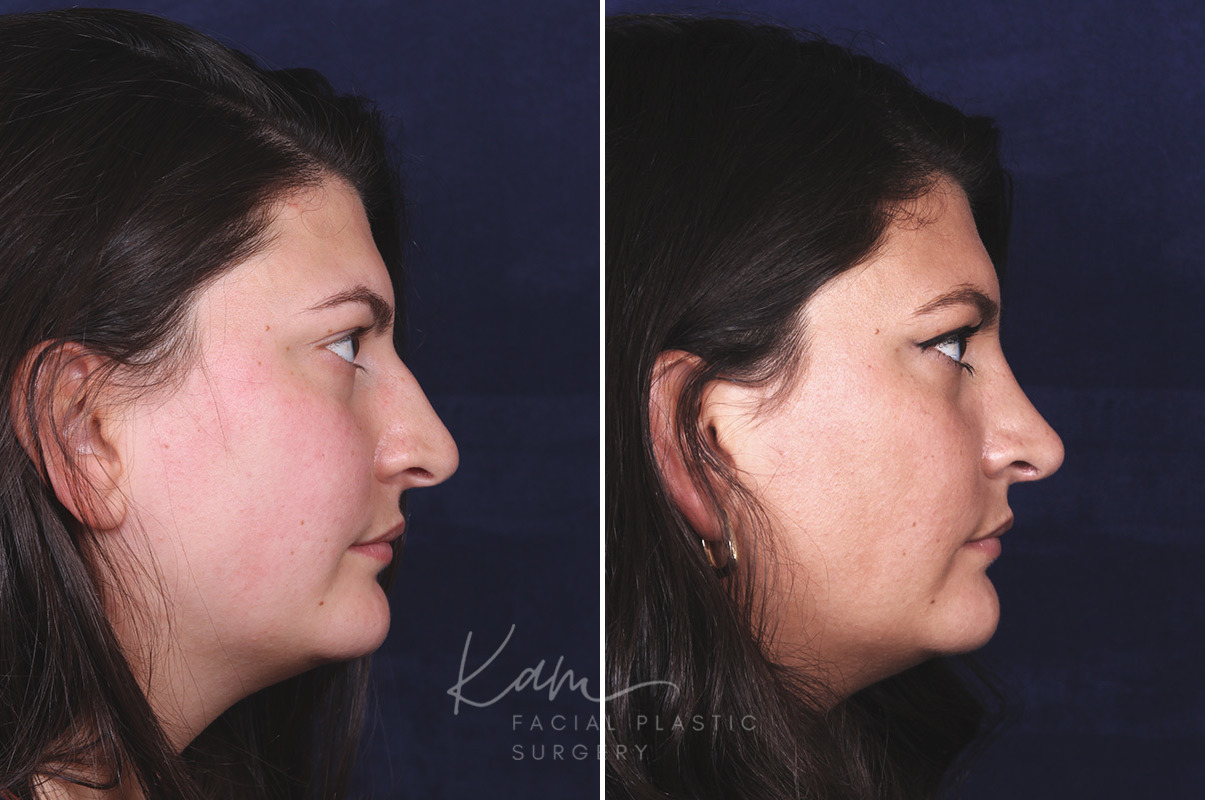 Rhinoplasty before and after photos in Voorhees, NJ, Patient 650