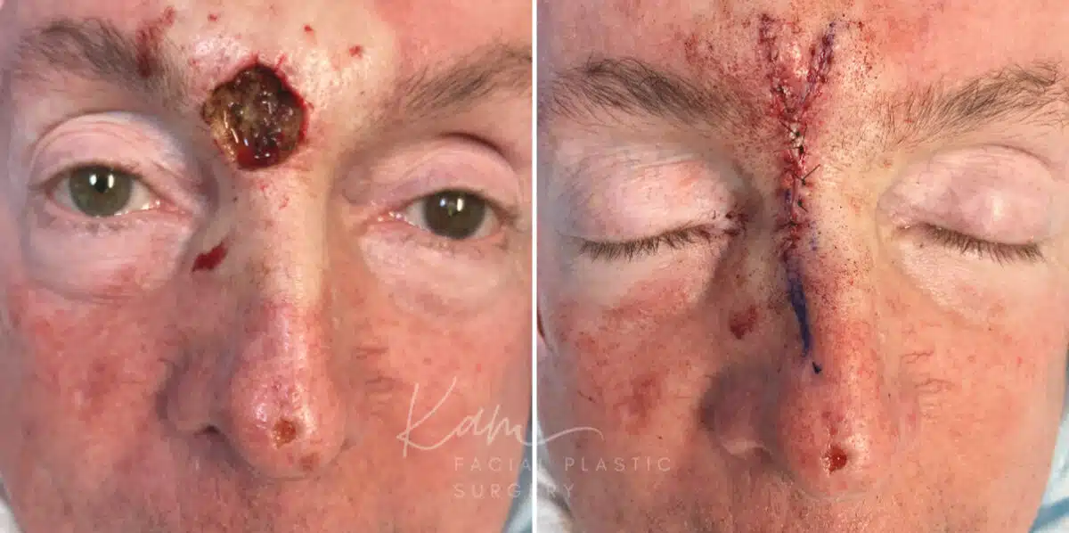 Mohs Reconstruction before and after photos in Voorhees, NJ, Patient 687