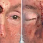 Mohs Reconstruction before and after photos in Voorhees, NJ, Patient 687