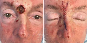 Mohs Reconstruction before and after photos in Voorhees, NJ, Patient 687