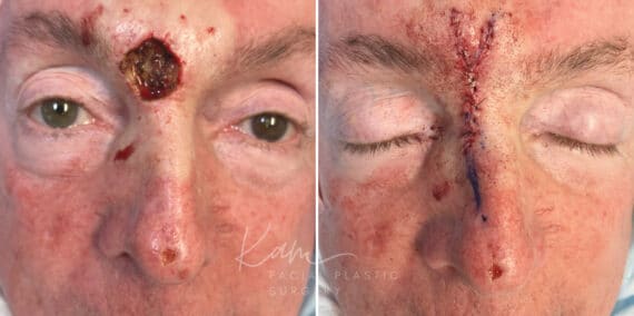 Mohs Reconstruction before and after photos in Voorhees, NJ, Patient 687