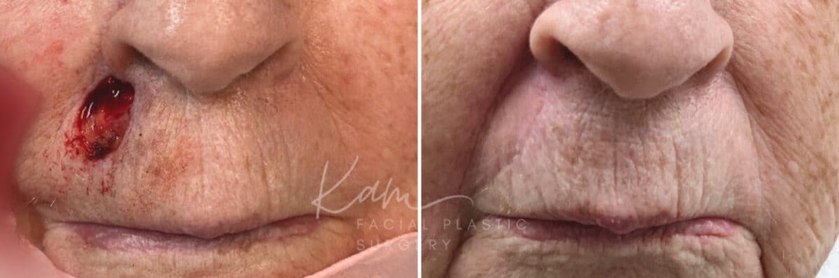 Mohs Reconstruction before and after photos in Voorhees, NJ, Patient 694