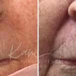 Mohs Reconstruction before and after photos in Voorhees, NJ, Patient 694