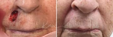 Mohs Reconstruction before and after photos in Voorhees, NJ, Patient 694