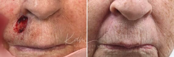Mohs Reconstruction before and after photos in Voorhees, NJ, Patient 694