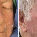 Mohs Reconstruction before and after photos in Voorhees, NJ, Patient 698