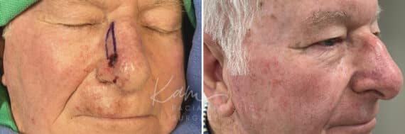 Mohs Reconstruction before and after photos in Voorhees, NJ, Patient 698