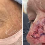Mohs Reconstruction before and after photos in Voorhees, NJ, Patient 702