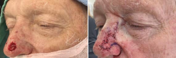 Mohs Reconstruction before and after photos in Voorhees, NJ, Patient 702
