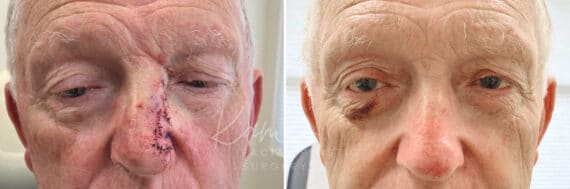 Mohs Reconstruction before and after photos in Voorhees, NJ, Patient 702