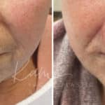 Mohs Reconstruction before and after photos in Voorhees, NJ, Patient 709
