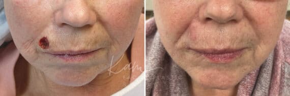 Mohs Reconstruction before and after photos in Voorhees, NJ, Patient 709