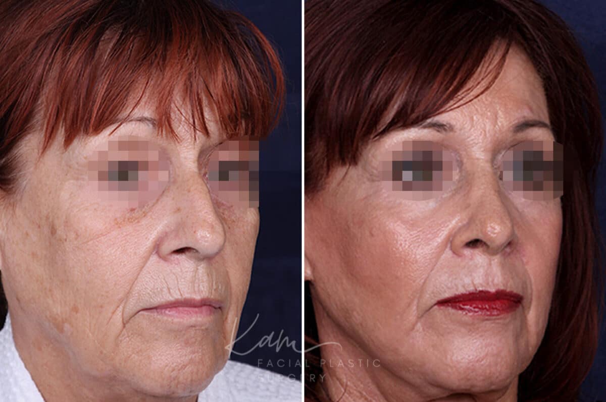 Rhinoplasty before and after photos in Voorhees, NJ, Patient 1198