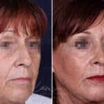 Rhinoplasty before and after photos in Voorhees, NJ, Patient 1198