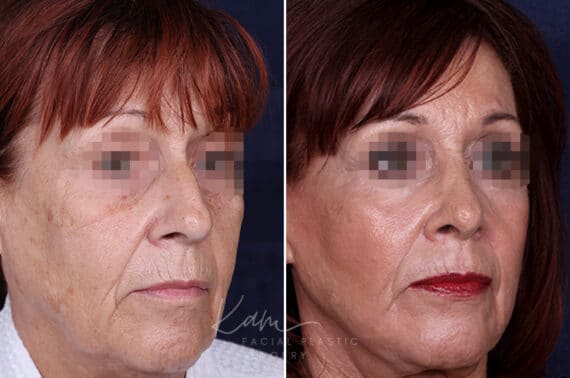 Rhinoplasty before and after photos in Voorhees, NJ, Patient 1198