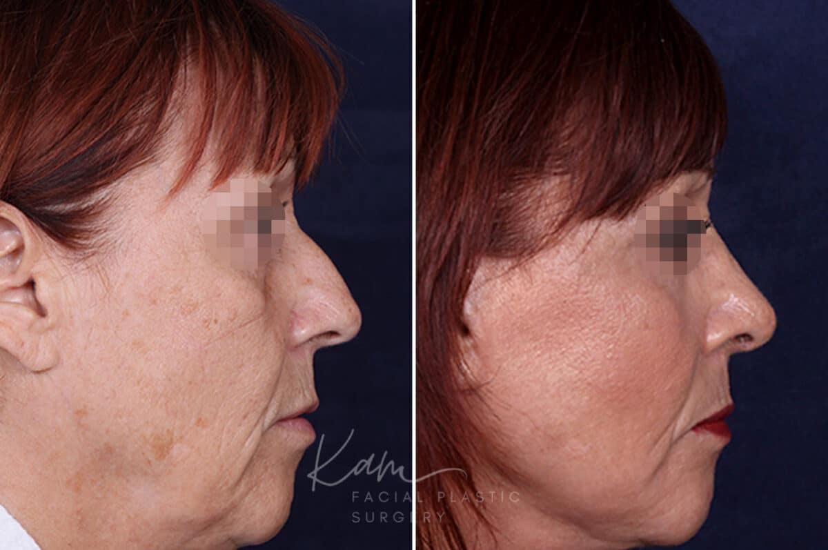 Rhinoplasty before and after photos in Voorhees, NJ, Patient 1198