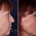 Rhinoplasty before and after photos in Voorhees, NJ, Patient 1198