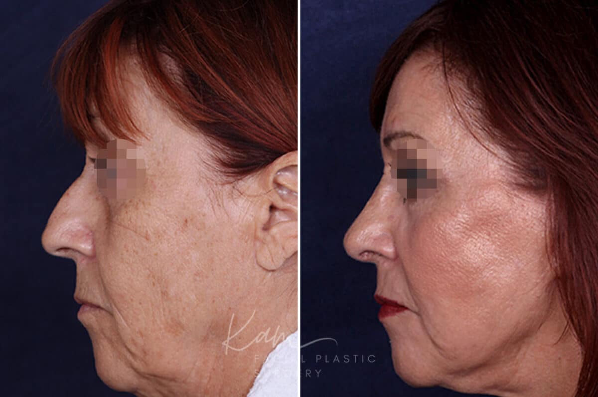 Rhinoplasty before and after photos in Voorhees, NJ, Patient 1198