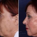 Rhinoplasty before and after photos in Voorhees, NJ, Patient 1198