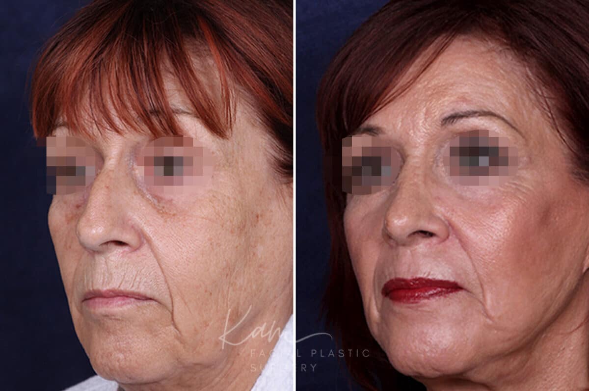 Rhinoplasty before and after photos in Voorhees, NJ, Patient 1198