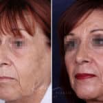 Rhinoplasty before and after photos in Voorhees, NJ, Patient 1198