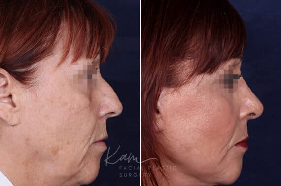Rhinoplasty before and after photos in Voorhees, NJ, Patient 1198