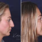 Rhinoplasty before and after photos in Voorhees, NJ, Patient 121