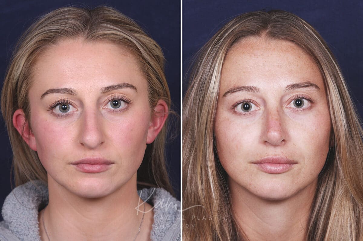 Rhinoplasty before and after photos in Voorhees, NJ, Patient 121