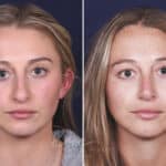 Rhinoplasty before and after photos in Voorhees, NJ, Patient 121