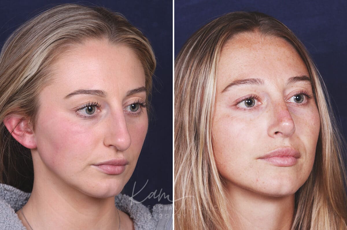 Rhinoplasty before and after photos in Voorhees, NJ, Patient 121