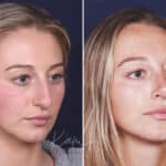 Rhinoplasty before and after photos in Voorhees, NJ, Patient 121