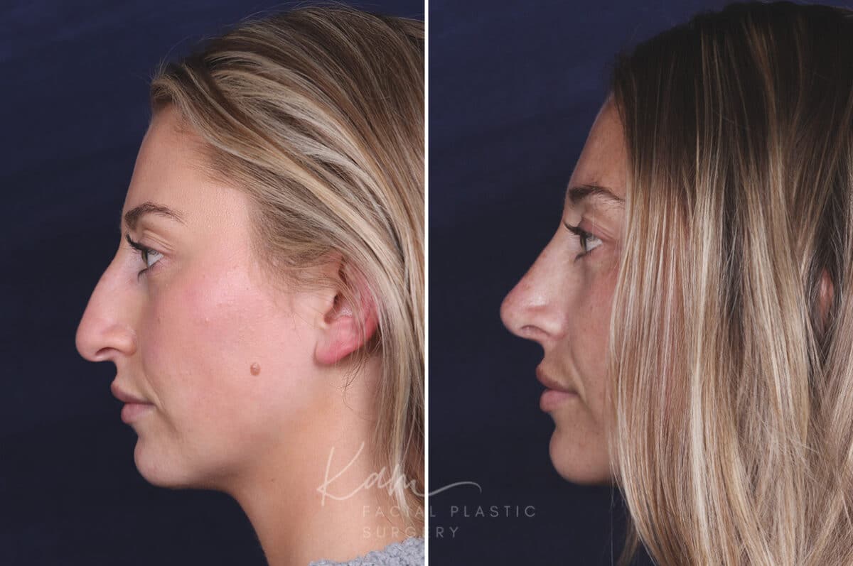 Rhinoplasty before and after photos in Voorhees, NJ, Patient 121