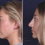 Rhinoplasty before and after photos in Voorhees, NJ, Patient 121