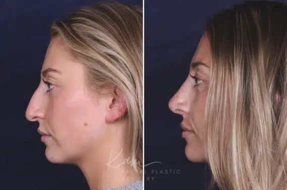 Rhinoplasty before and after photos in Voorhees, NJ, Patient 121