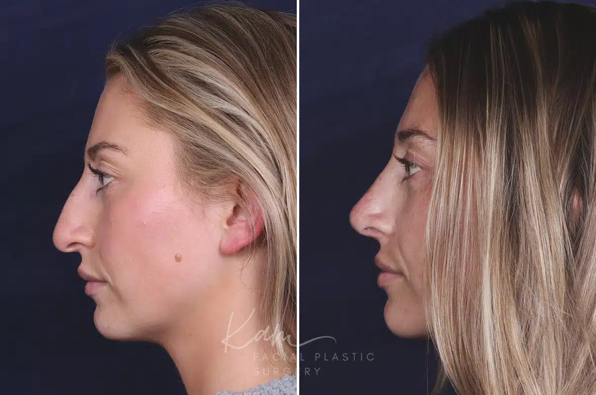 Rhinoplasty before and after photos in Voorhees, NJ, Patient 121