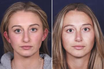 Rhinoplasty before and after photos in Voorhees, NJ, Patient 121