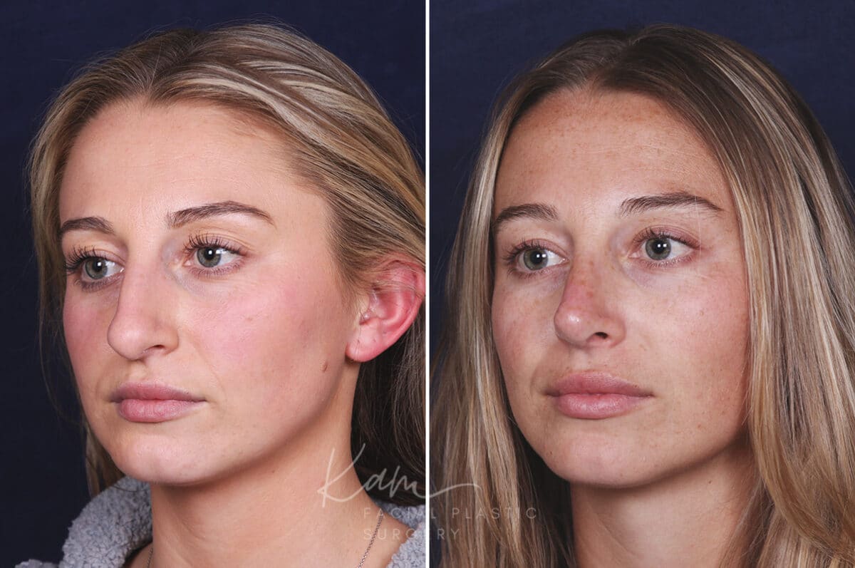 Rhinoplasty before and after photos in Voorhees, NJ, Patient 121