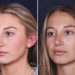 Rhinoplasty before and after photos in Voorhees, NJ, Patient 121